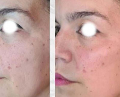 aumento de pómulos madrid