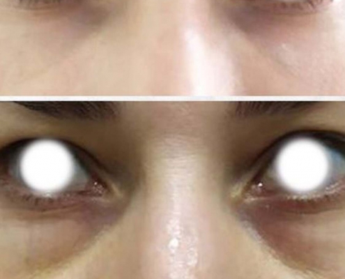 eliminar ojeras madrid