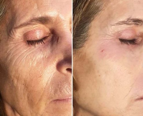 lifting facial medicina estética madrid