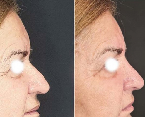rinomodelacion sin cirugía