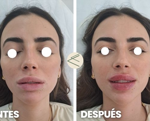 aumento de labios